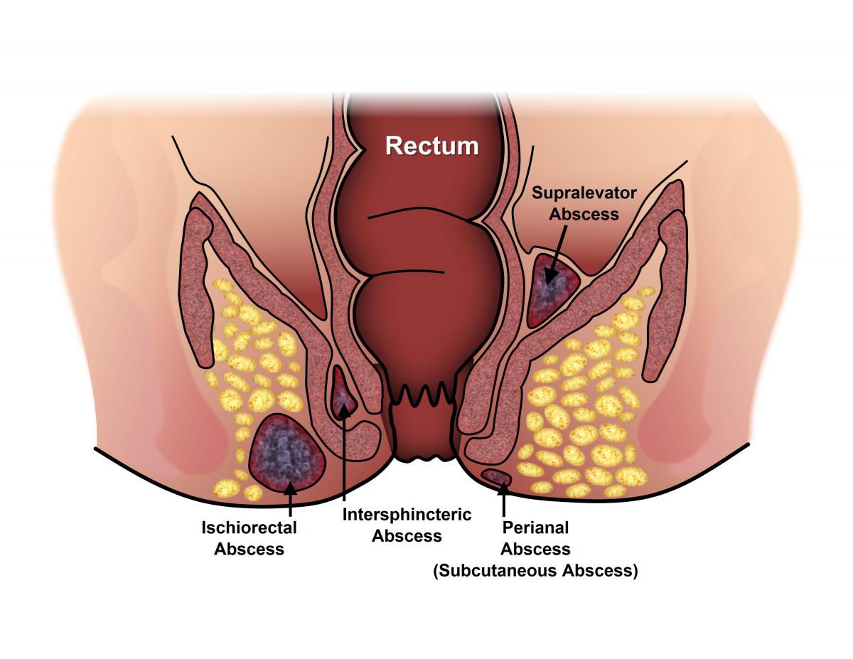 prostatitis és fistula