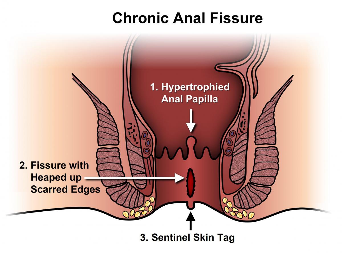 Anal treatment procedure