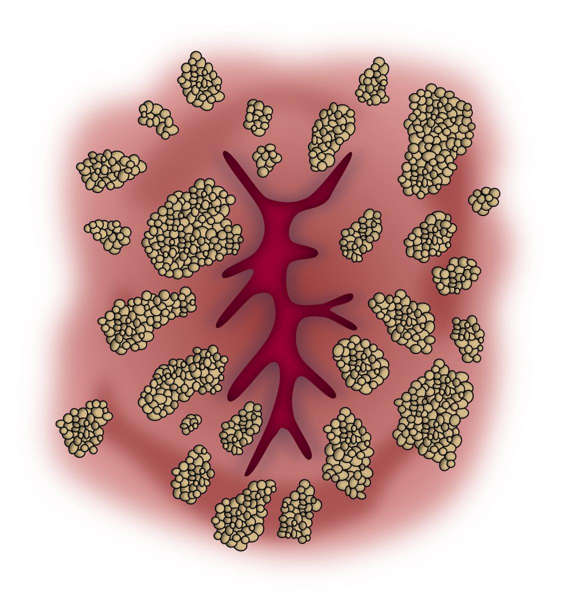 Anal Warts and Anal Dysplasia Expanded Information ASCRS picture