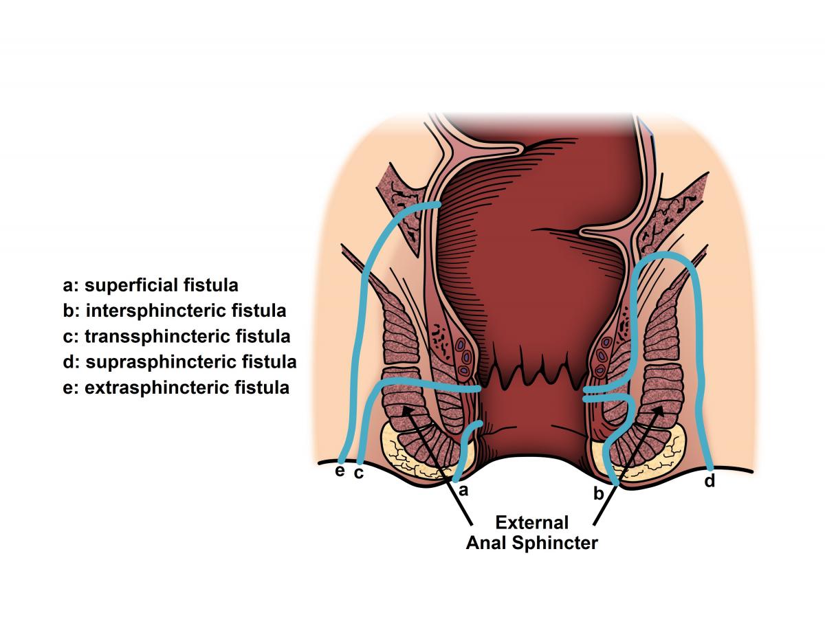 perirectal abscess