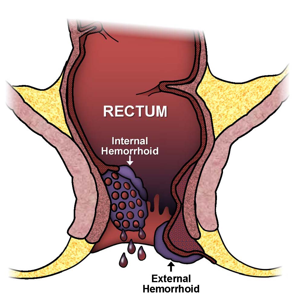 Rectal cancer vs hemorrhoid. Rectal cancer or hemorrhoid. Rectal cancer versus hemorrhoids