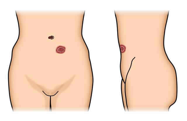 Ostomy Expanded Version