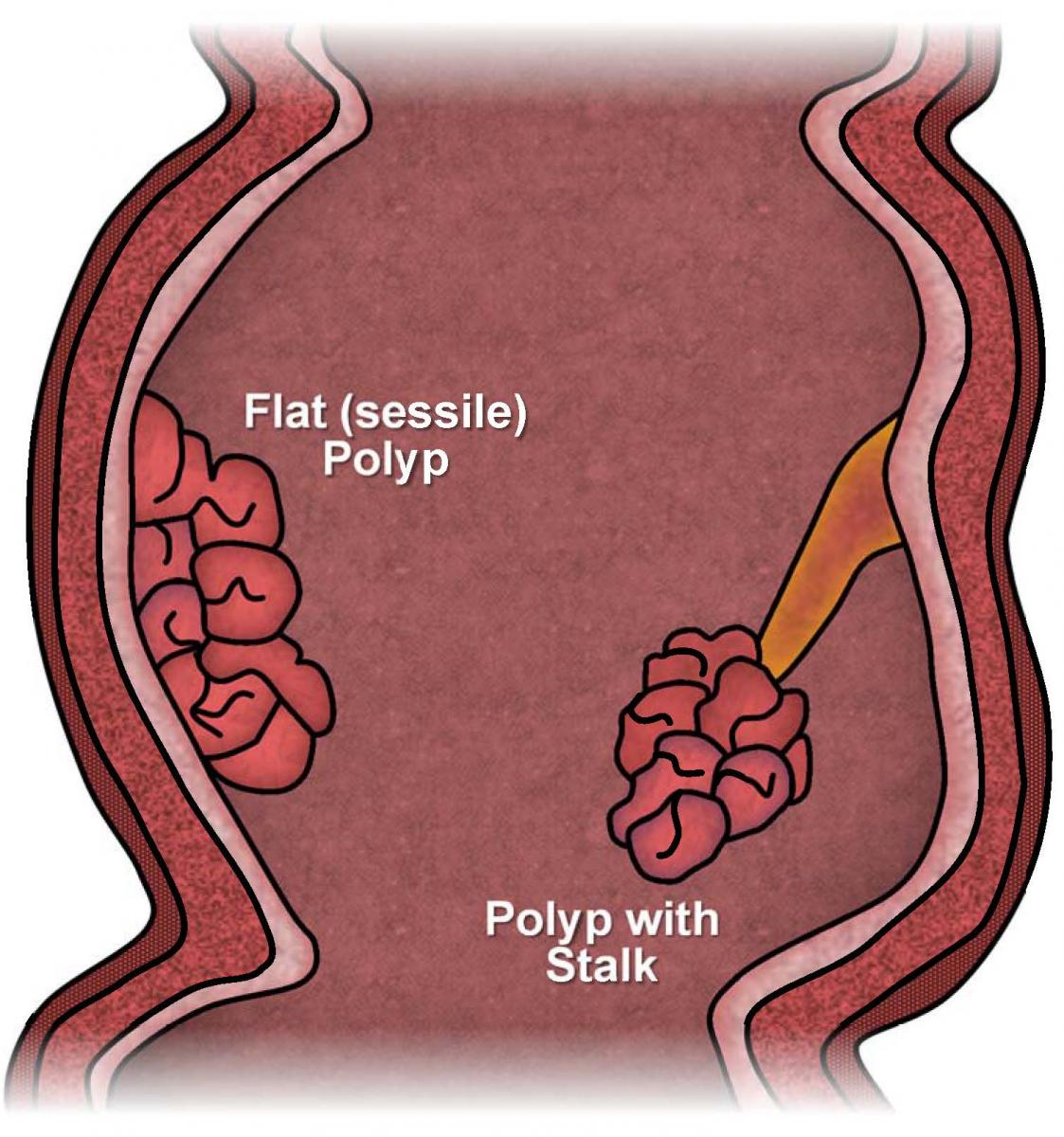 hpv and colon polyps
