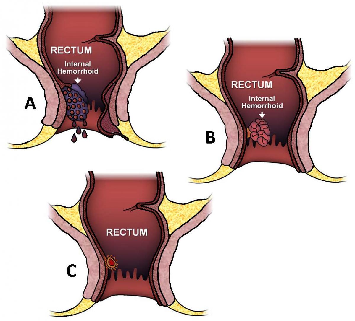 thrombosed-external-hemorrhoid-treatment-youtube