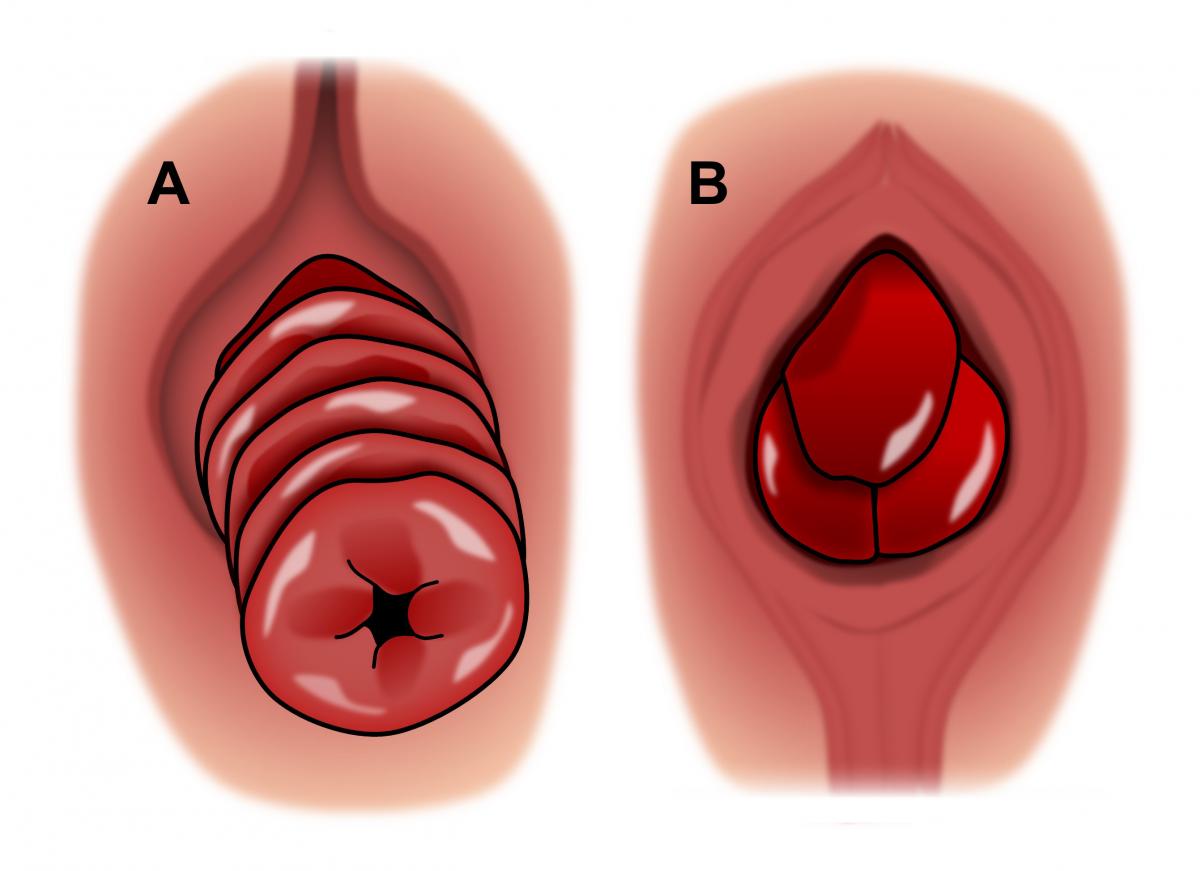 Prolapse