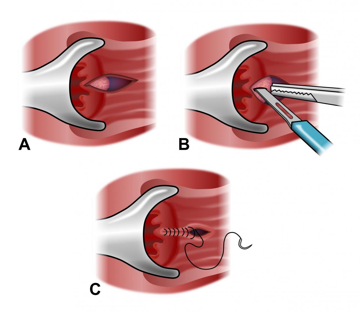 Anal treatment procedure