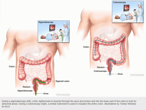 Rectal Prolapse