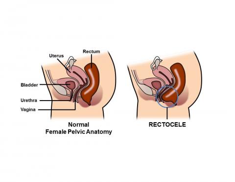 perineal hernia in women