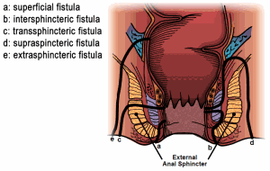 Kinds of fistulas diagram