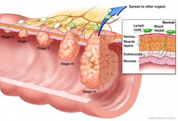 Hpv colon cancer - Meniu cont utilizator