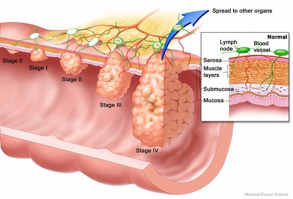 human papillomavirus colon cancer