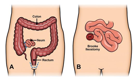 Ulcerative Colitis: Symptoms, Causes, Treatment, and Prevention