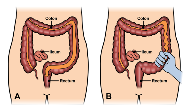 Irritable Bowel Syndrome Expanded Version Ascrs